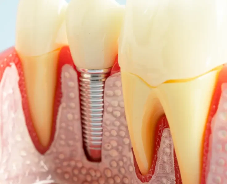 Dental Implants in Edmonton
