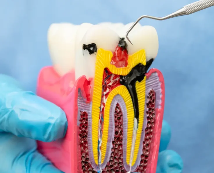Root Canal Treatment in Edmonton