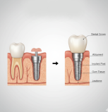 Dental Implants in Edmonton